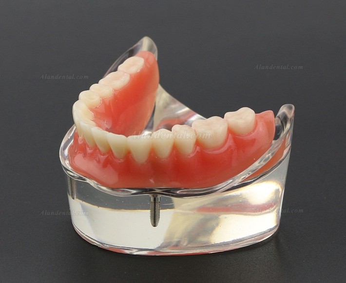 Dental Teeth Model Overdenture Inferior with 2 Implants Study Demo Model 6002 01